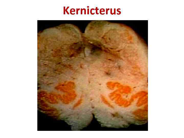 Kernicterus 