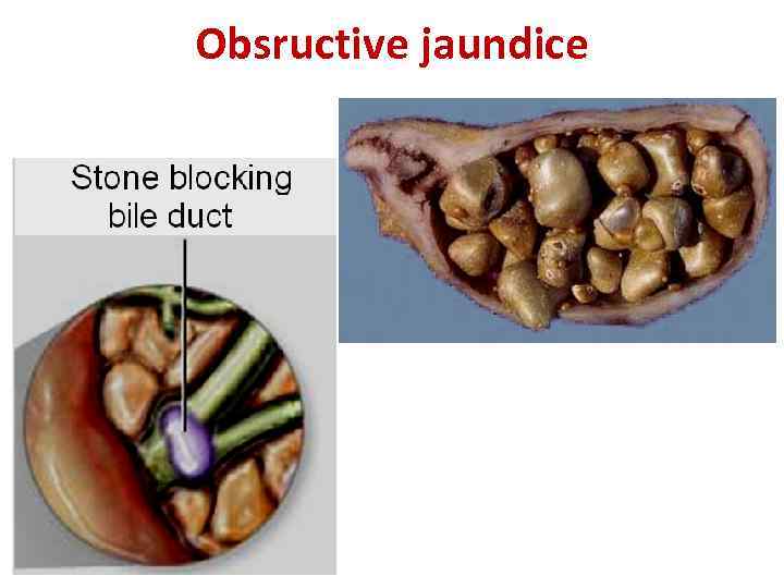 Obsructive jaundice 