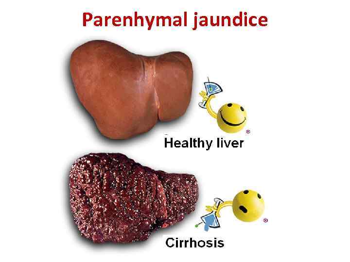 Parenhymal jaundice 