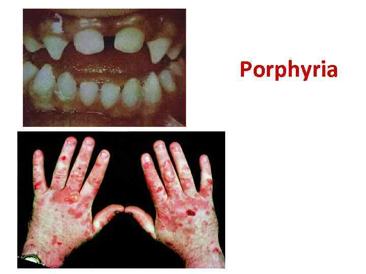 Porphyria 