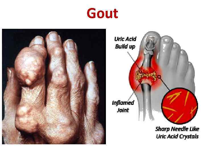 Gout 