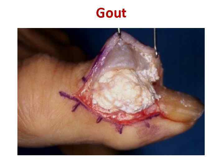 Gout 