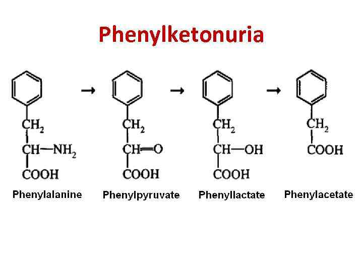 Phenylketonuria 