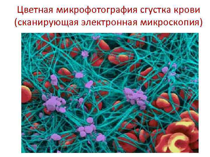 Цветная микрофотография сгустка крови (сканирующая электронная микроскопия) 