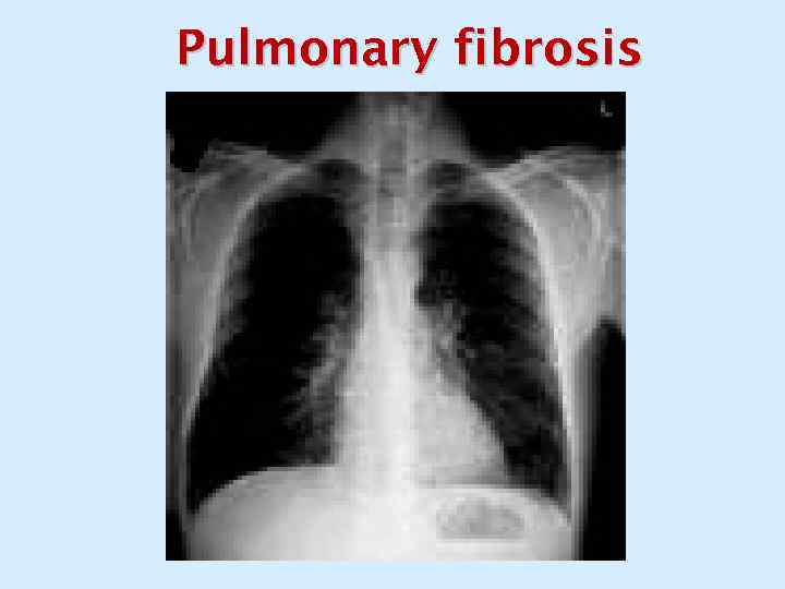 Pulmonary fibrosis 