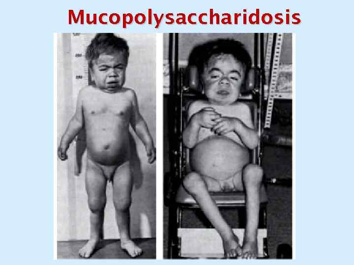 Mucopolysaccharidosis 