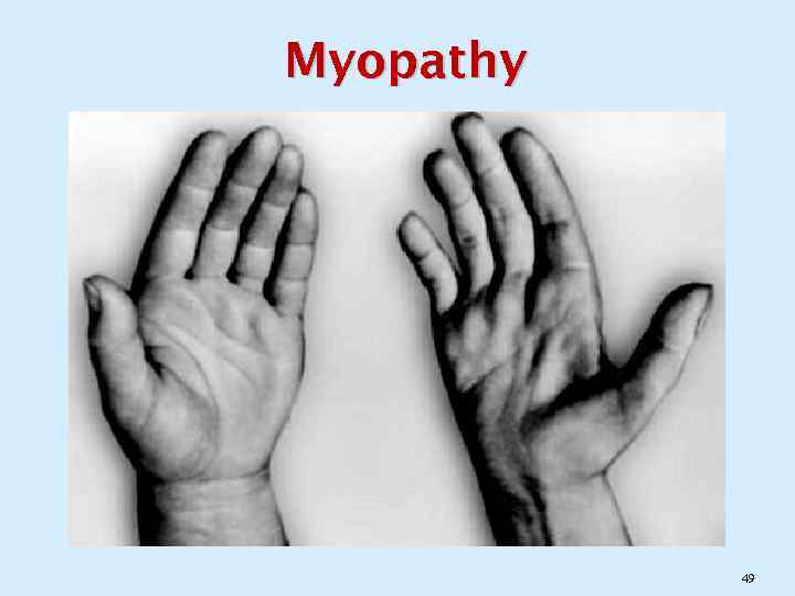 Myopathy 49 