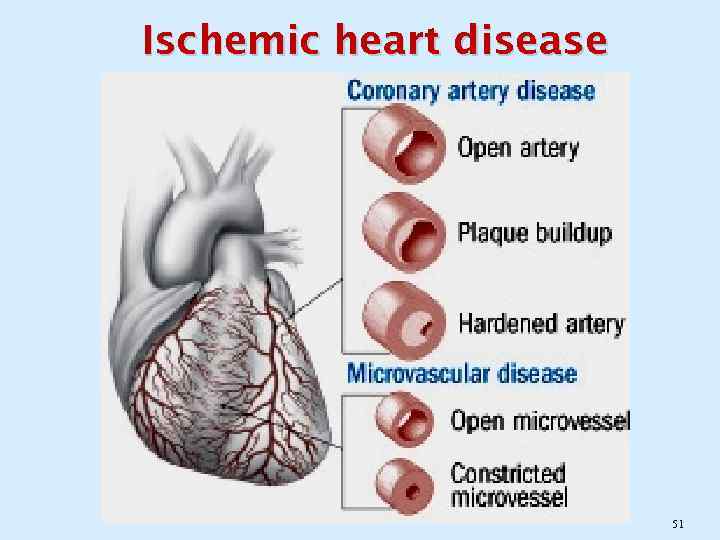 Ischemic heart disease 51 