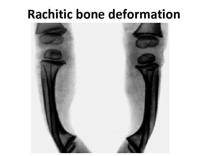 Rachitic bone deformation 