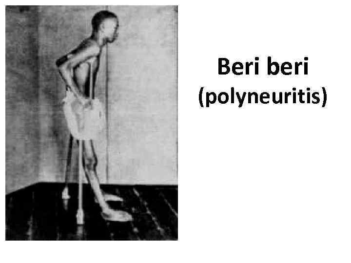 Beri beri (polyneuritis) 