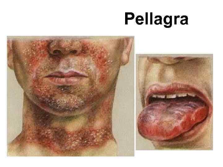 Pellagra 