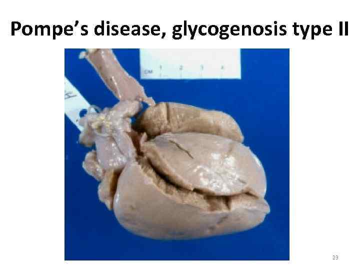 Pompe’s disease, glycogenosis type II 23 