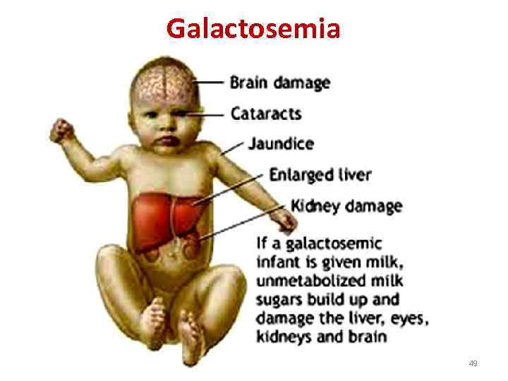 Galactosemia 49 