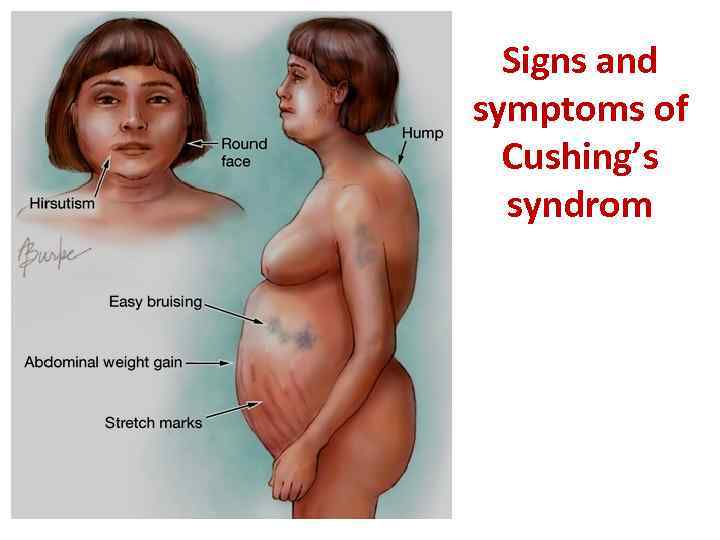 Signs and symptoms of Cushing’s syndrom 