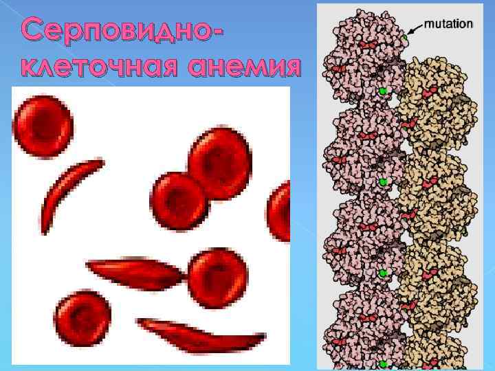 Серповидноклеточная анемия 