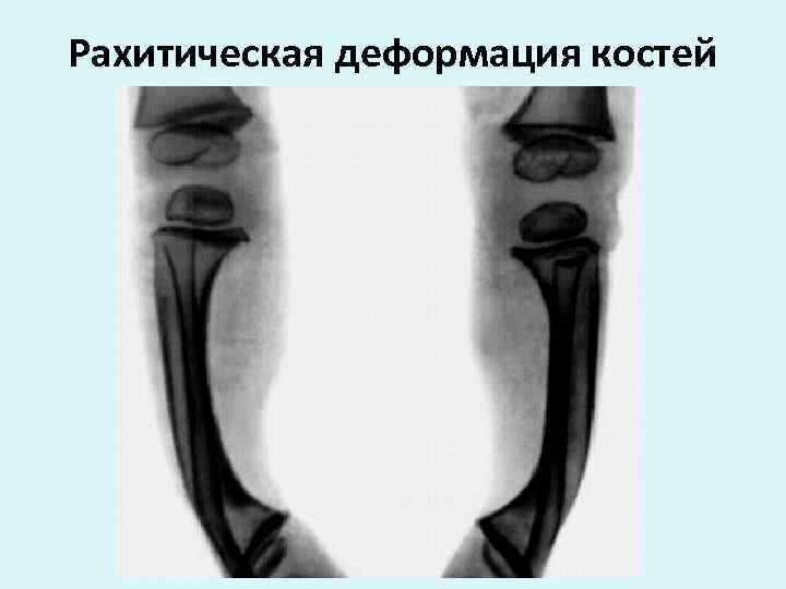 Рахитическая деформация костей 