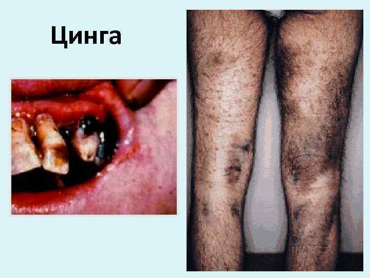 Цинга 