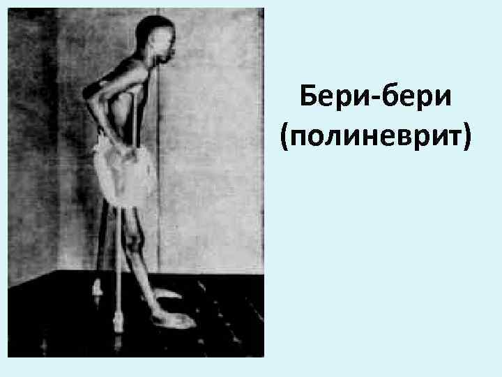 Бери-бери (полиневрит) 