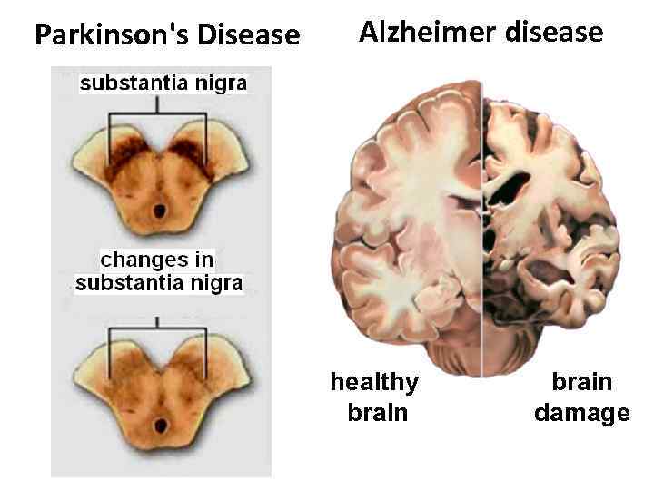 Parkinson's Disease Alzheimer disease healthy brain damage 