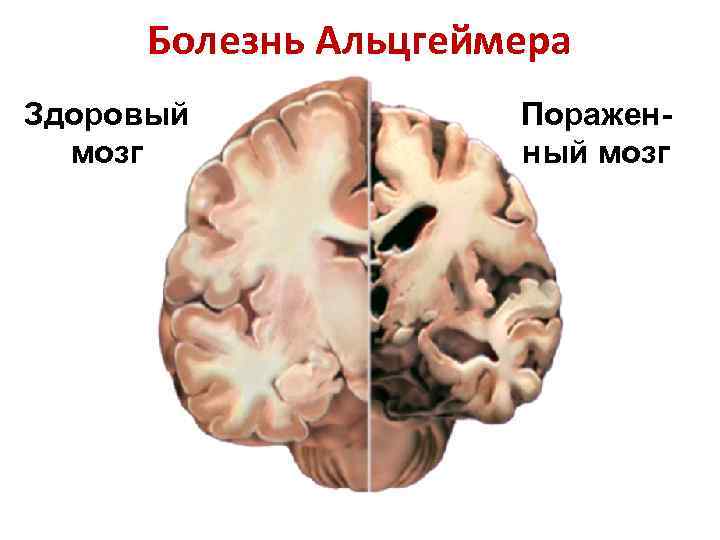 Болезнь Альцгеймера Здоровый мозг Пораженный мозг 