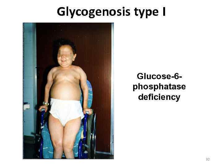 Glycogenosis type I Glucose-6 phosphatase deficiency 32 