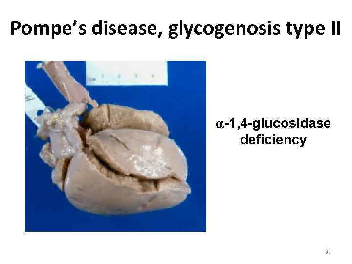 Pompe’s disease, glycogenosis type II -1, 4 -glucosidase deficiency 33 