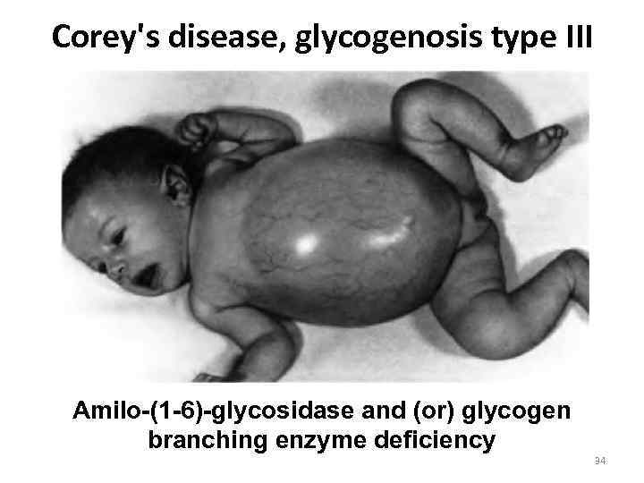 Corey's disease, glycogenosis type III Amilo-(1 -6)-glycosidase and (or) glycogen branching enzyme deficiency 34