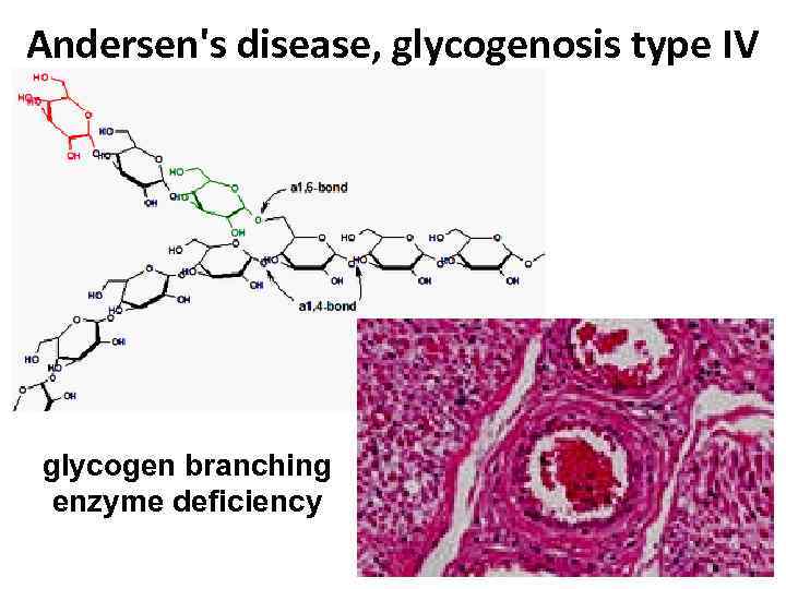 Andersen's disease, glycogenosis type IV glycogen branching enzyme deficiency 35 