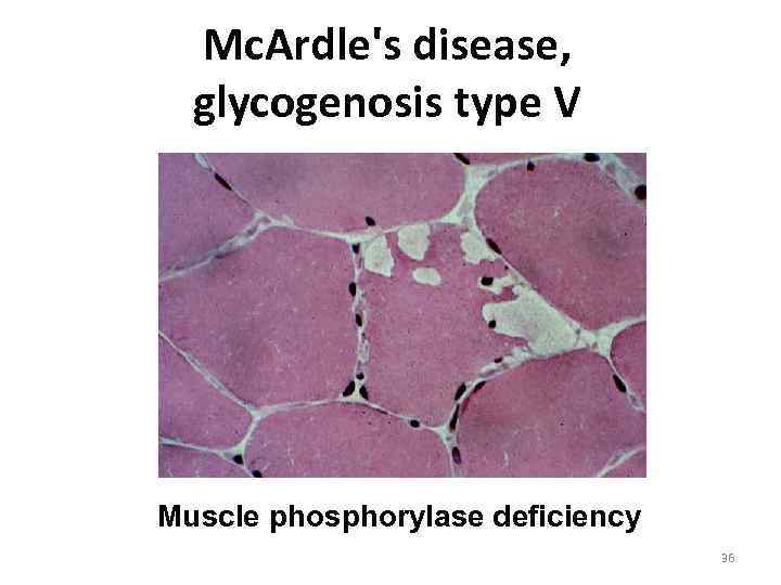 Mc. Ardle's disease, glycogenosis type V Muscle phosphorylase deficiency 36 