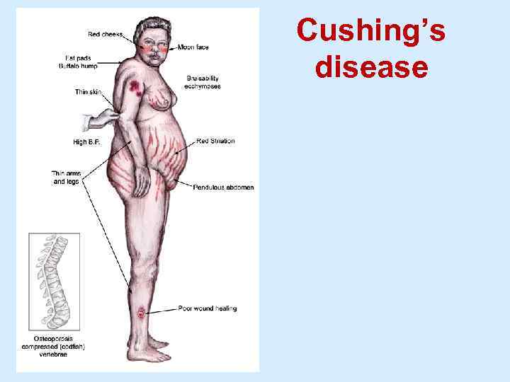 Cushing’s disease 