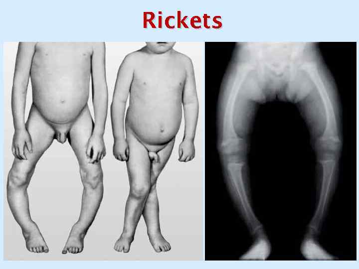 Rickets 