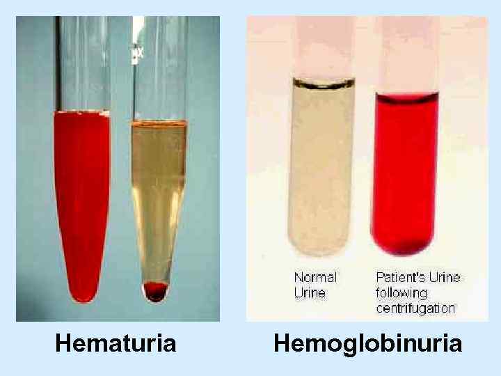 Hematuria Hemoglobinuria 