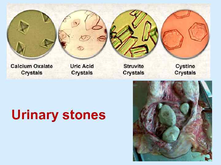 Urinary stones 