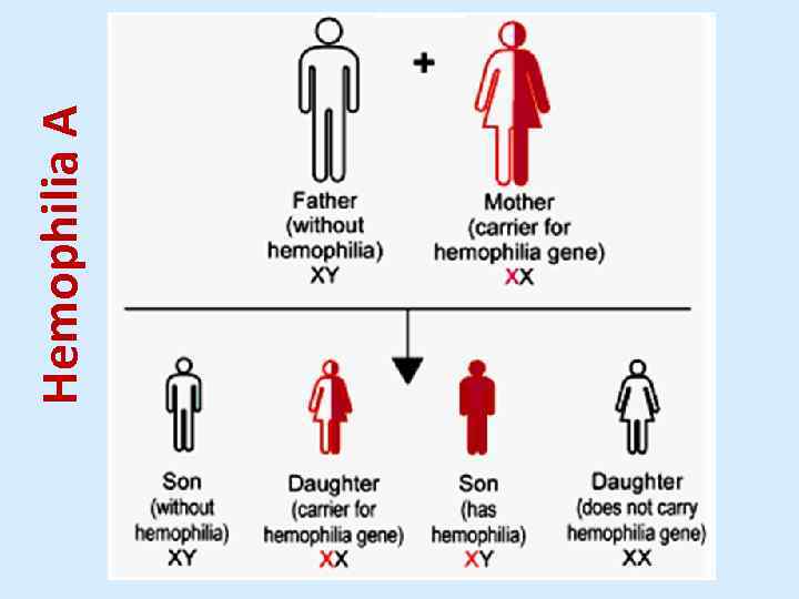 Hemophilia A 