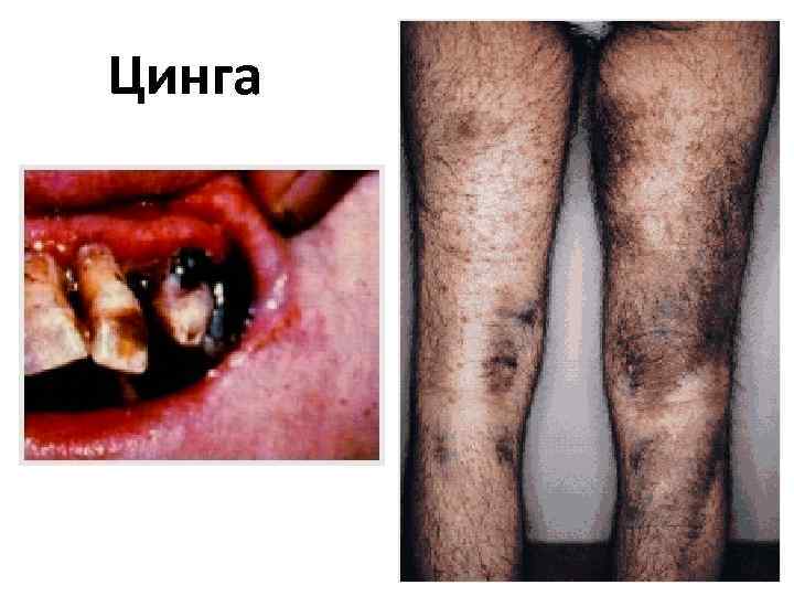 Цинга 