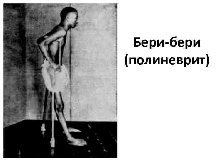 Бери-бери (полиневрит) 