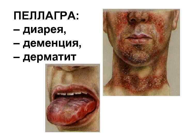 ПЕЛЛАГРА: – диарея, – деменция, – дерматит 
