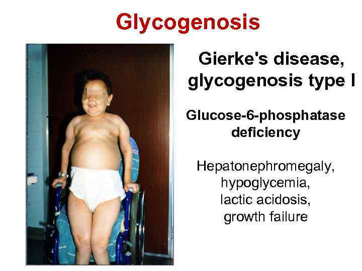 Glycogenosis Gierke's disease, glycogenosis type I Glucose-6 -phosphatase deficiency Hepatonephromegaly, hypoglycemia, lactic acidosis, growth