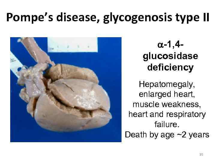 Pompe’s disease, glycogenosis type II -1, 4 glucosidase deficiency Hepatomegaly, enlarged heart, muscle weakness,