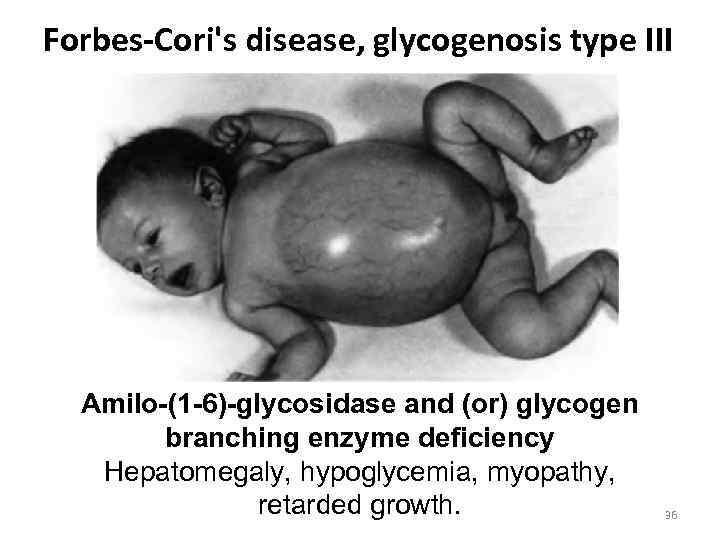 Forbes-Cori's disease, glycogenosis type III Amilo-(1 -6)-glycosidase and (or) glycogen branching enzyme deficiency Hepatomegaly,