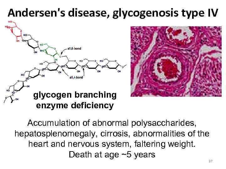 Andersen's disease, glycogenosis type IV glycogen branching enzyme deficiency Accumulation of abnormal polysaccharides, hepatosplenomegaly,