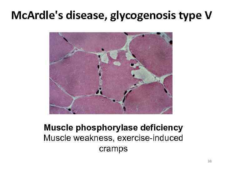 Mc. Ardle's disease, glycogenosis type V Muscle phosphorylase deficiency Muscle weakness, exercise-induced cramps 38