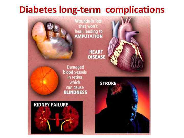 Diabetes long-term complications 