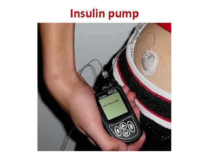 Insulin pump 