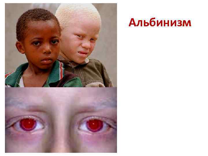 Альбинизм 