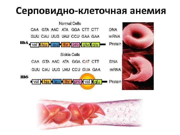 Серповидно-клеточная анемия 