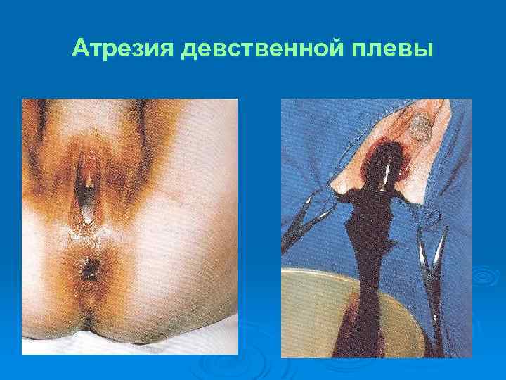 Атрезия девственной плевы 