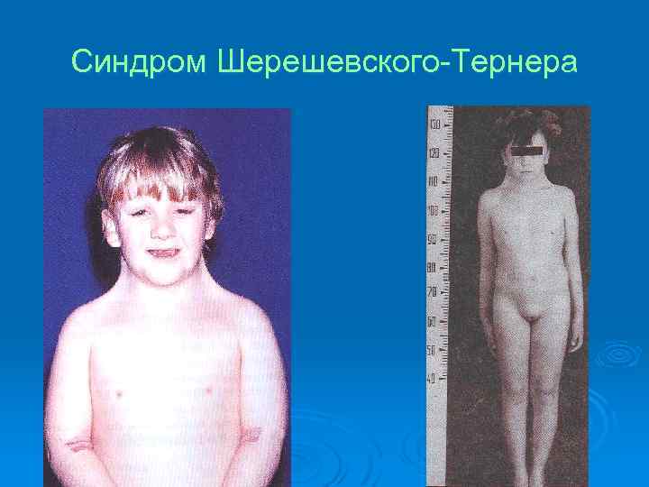 Синдром Шерешевского-Тернера 