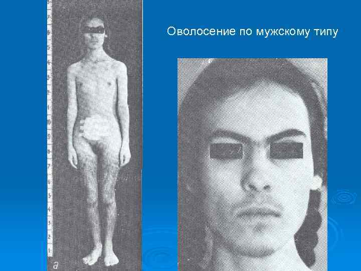 Оволосение по мужскому типу 