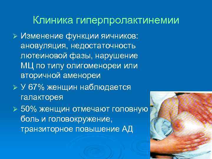 Клиника гиперпролактинемии Изменение функции яичников: ановуляция, недостаточность лютеиновой фазы, нарушение МЦ по типу олигоменореи